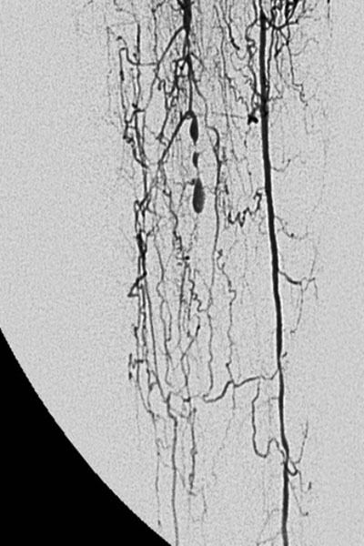 Radiografía vascular de la pierna del paciente antes de recibir el tratamiento.