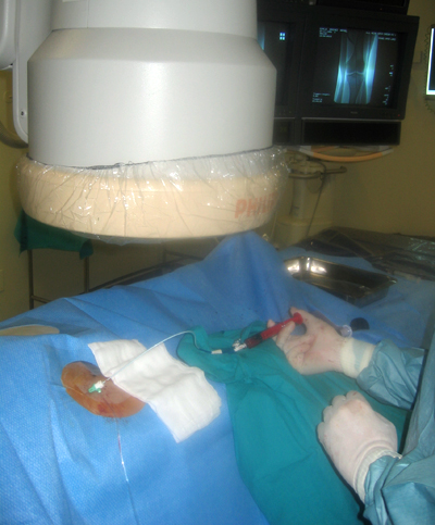 Infusión de células madre que reciben los pacientes.
